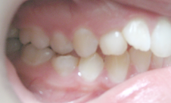 brentwood orthodontics before