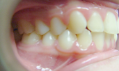 brentwood orthodontics before