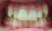 brentwood orthodontics before